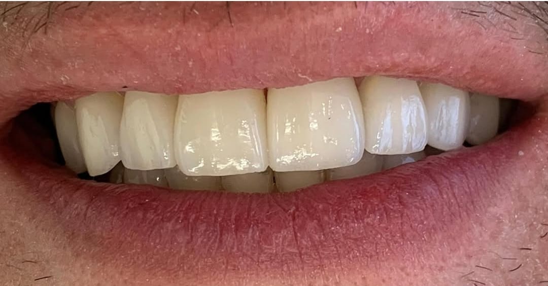 Resultado clínico de prótese dentária da Magnus Odontologia